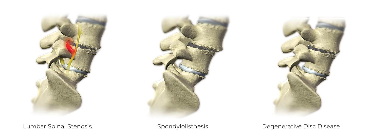 Spine Illustrations for Conditions