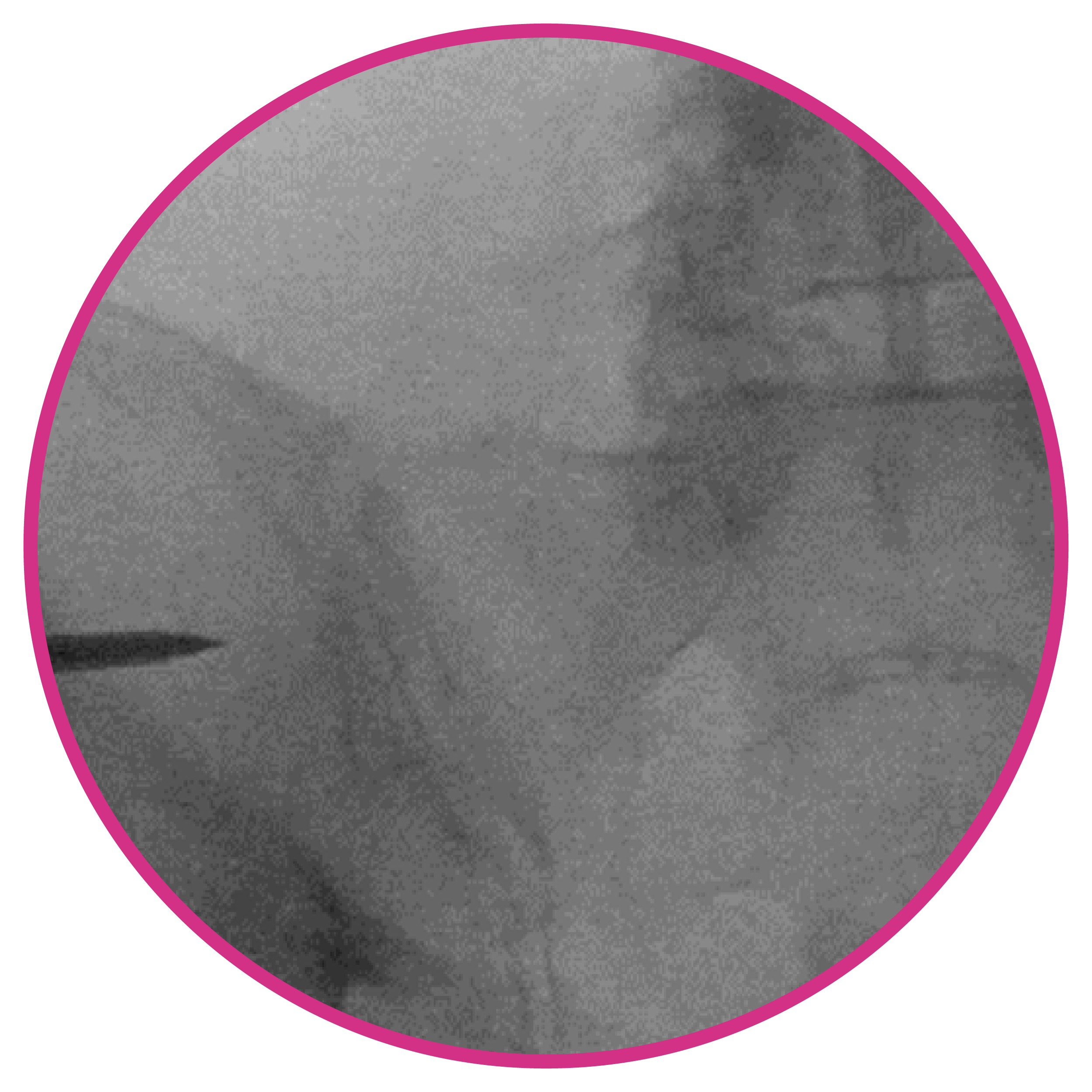 SI Joint X-Ray outlet view pre implant