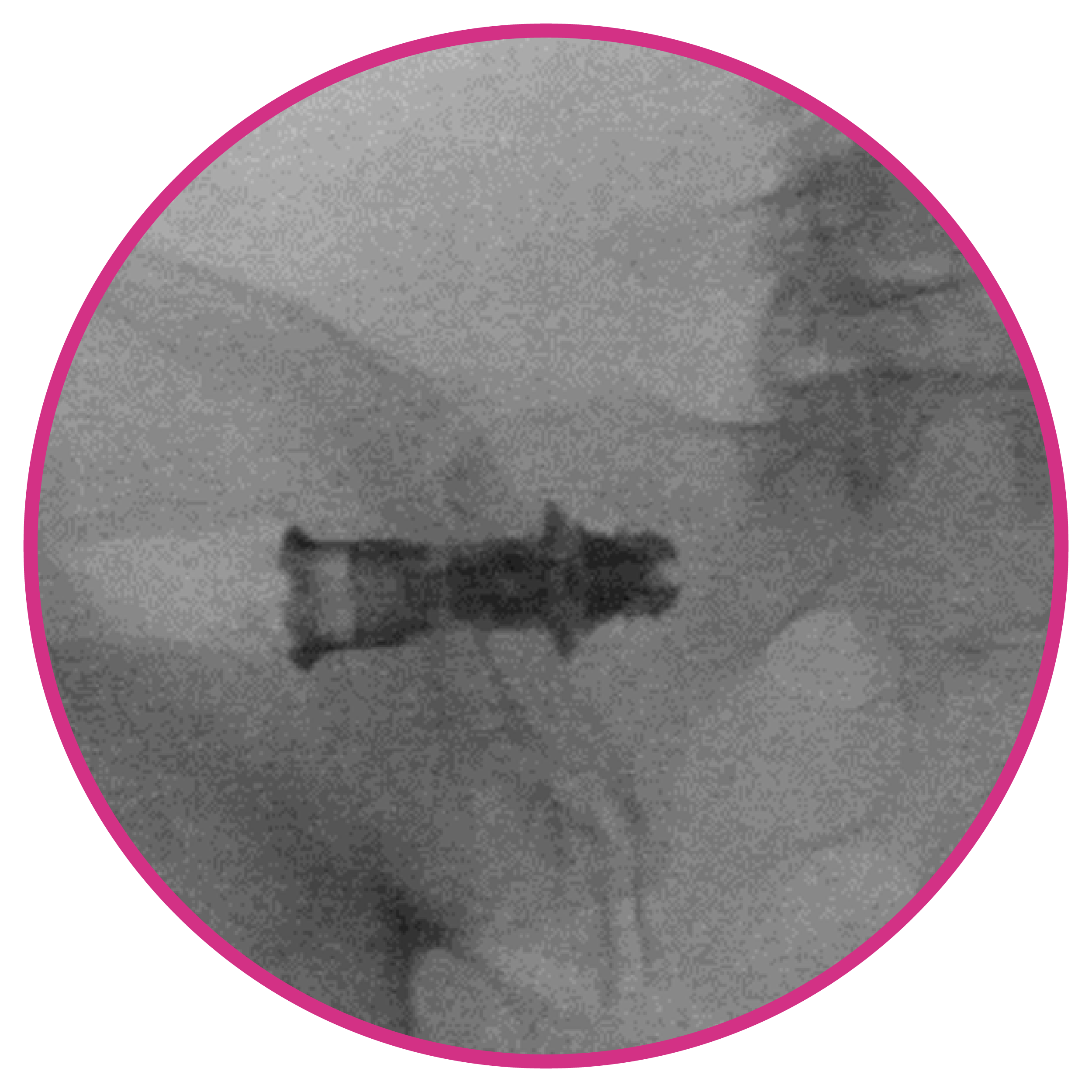 SI joint X-Ray outlet view post implant